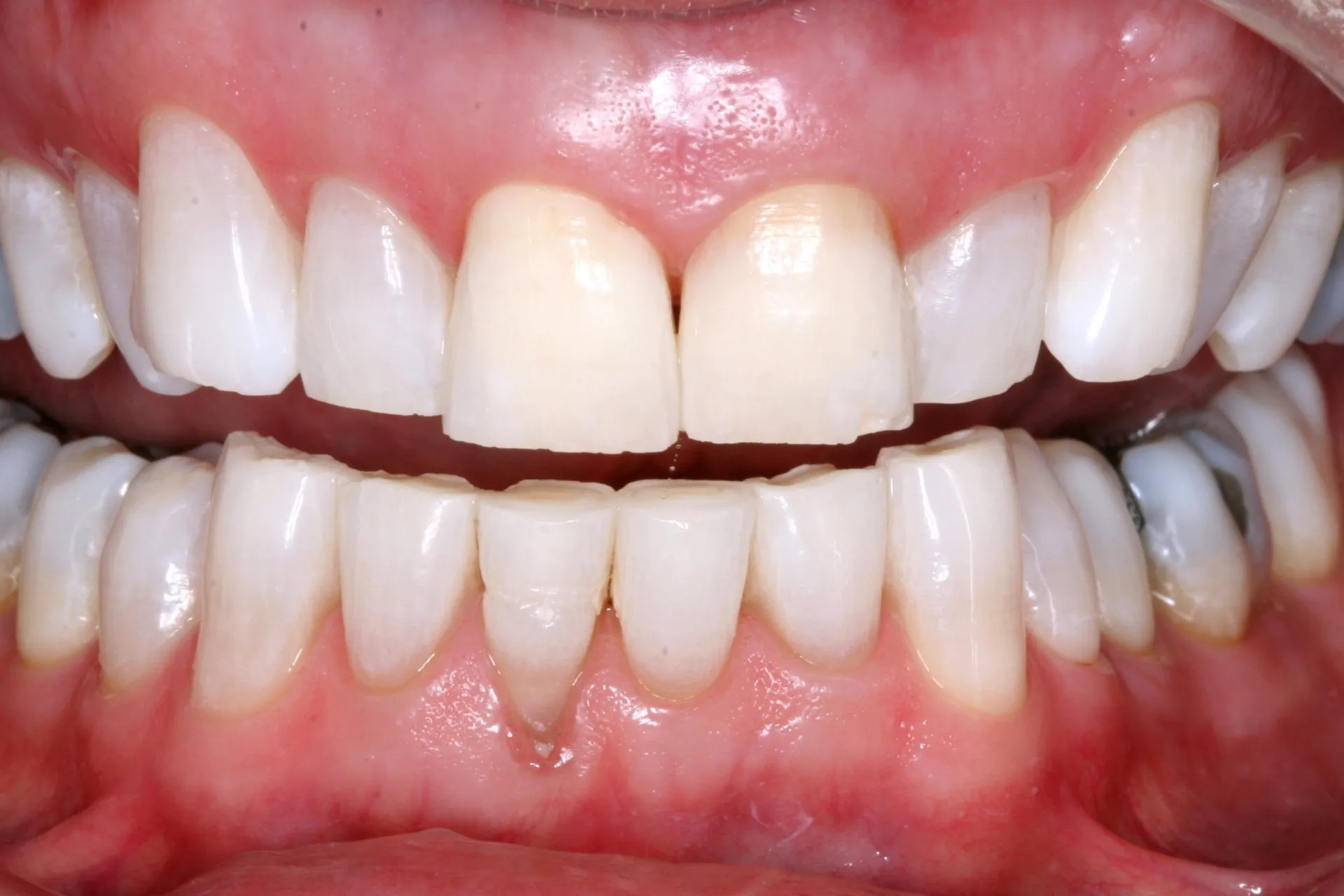 Close-up of two rows of teeth after KöR Whitening