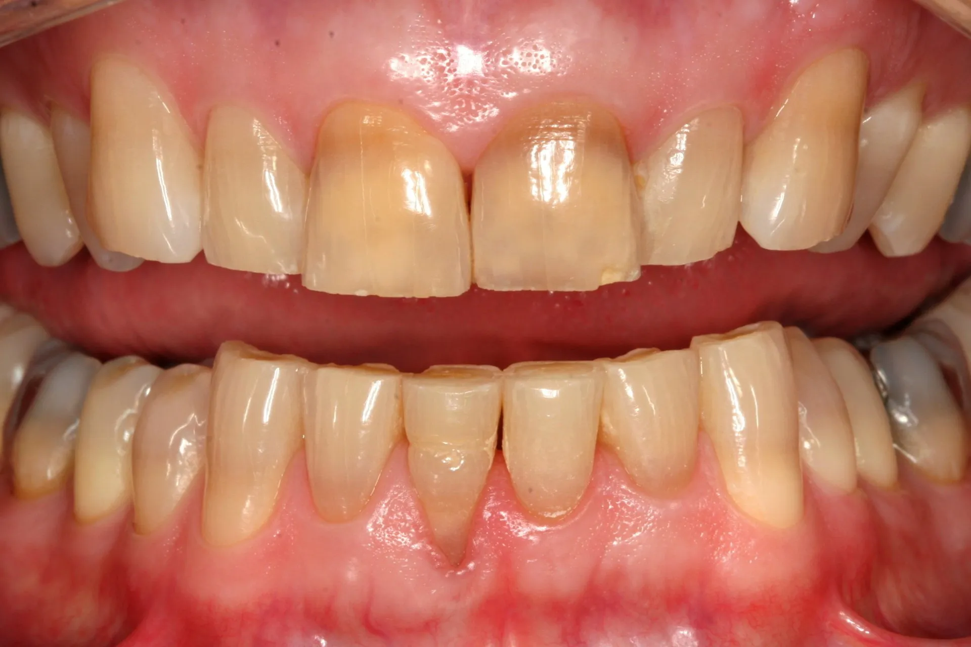Close-up of two rows of teeth before KöR Whitening