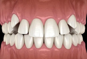3D illustration of crossbite showing upper and lower teeth misaligned horizontally