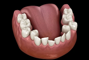3D illustration of crowded teeth showing overlapping and misaligned lower teeth