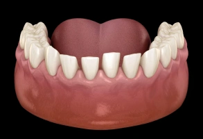 3D illustration of gapped teeth showing spaces between lower front teeth
