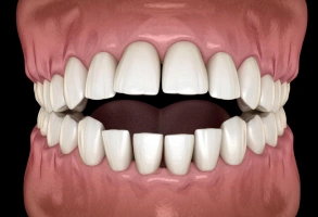 3D illustration of open bite showing upper and lower front teeth not meeting when closed