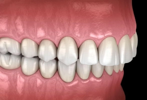 3D illustration of overbite showing upper front teeth overlapping lower teeth
