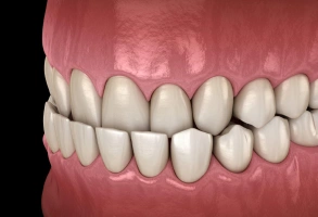 3D illustration of underbite showing lower front teeth extending beyond upper teeth