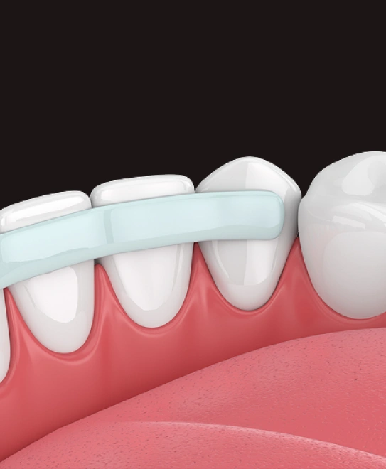 3D illustration of dental bonding procedure showing composite resin applied to front teeth
