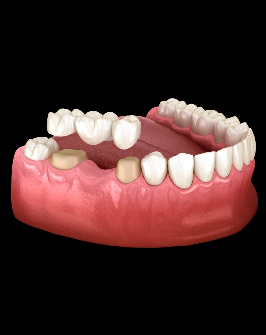 3D model of a dental bridge showing tooth replacement on lower jaw