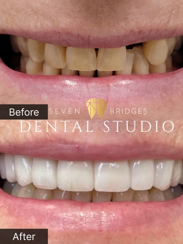 Before and after dental implant results showing natural-looking single tooth replacement at Seven Bridges Dental Studio in Woodridge, IL