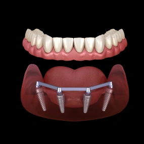 3D model showing All-on-4 dental implants supporting a full arch of upper teeth