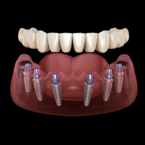 3D model showing All-on-6 dental implants supporting a full arch of lower teeth