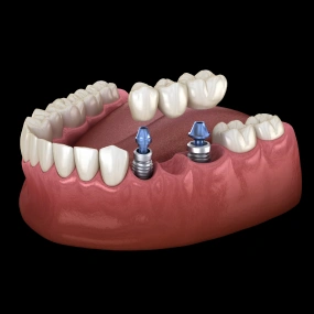 3D model of implant-supported bridge showing two implants anchoring replacement teeth on lower jaw