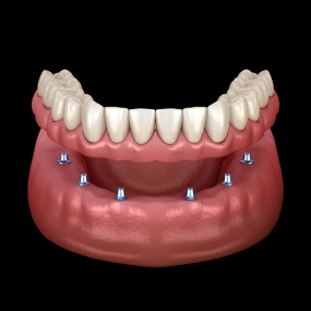 3D model of implant-supported dentures showing multiple implants securing a full lower arch