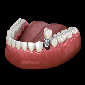 3D model of a single dental implant replacing one missing tooth on lower jaw
