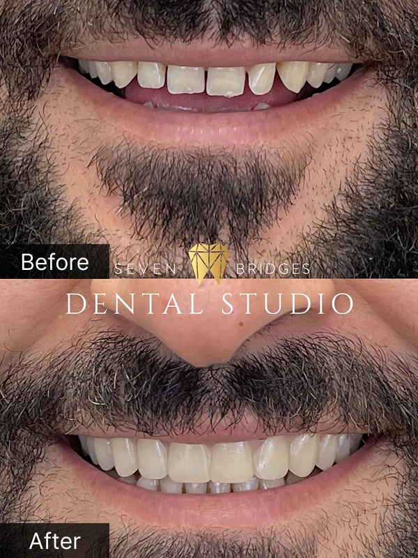 Before and after dentures results for male patient showing full smile restoration at Seven Bridges Dental Studio in Woodridge, IL
