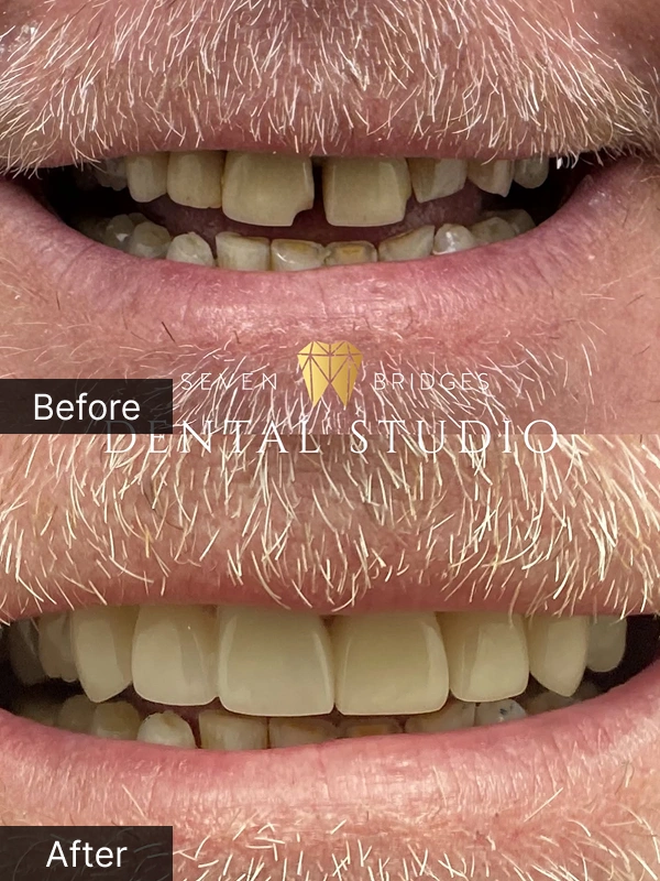 Before and after dentures treatment showing improved tooth alignment and restored smile for male patient at Seven Bridges Dental Studio in Woodridge, IL
