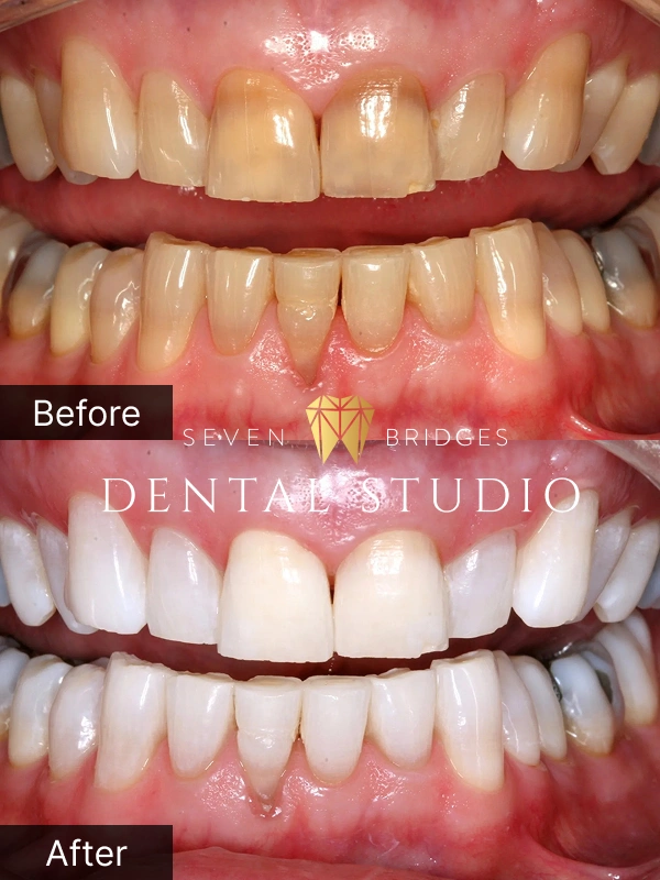 Before and after KöR teeth whitening results showing significantly whiter and brighter smile at Seven Bridges Dental Studio in Woodridge, IL