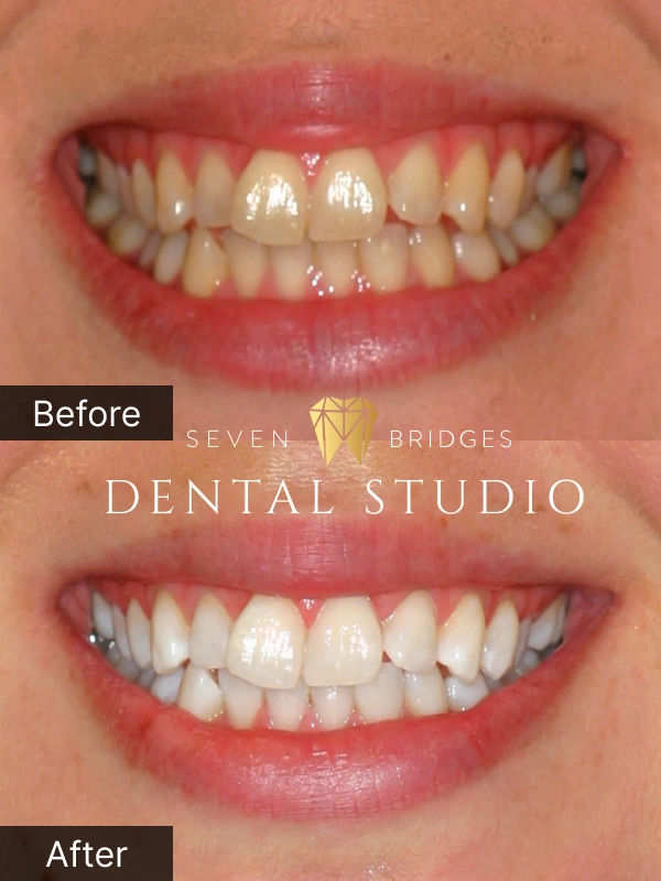 Before and after KöR whitening results showing visibly brighter and whiter smile transformation at Seven Bridges Dental Studio in Woodridge, IL