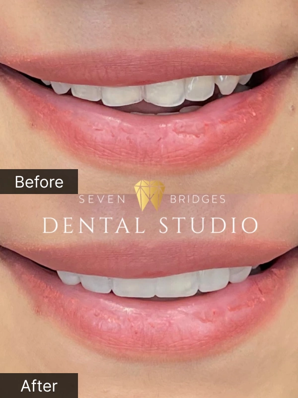 Before and after porcelain veneers results showing even, natural-white smile transformation for female patient at Seven Bridges Dental Studio in Woodridge, IL