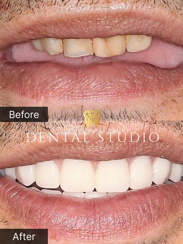 Before and after denture results showing dramatically whiter and aligned smile at Seven Bridges Dental Studio in Woodridge, IL
