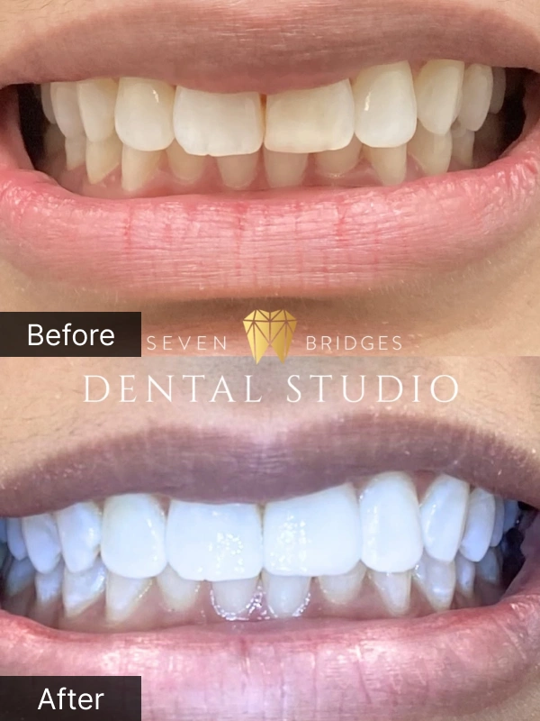 Before and after teeth whitening results showing dramatically brighter and whiter smile for female patient at Seven Bridges Dental Studio in Woodridge, IL