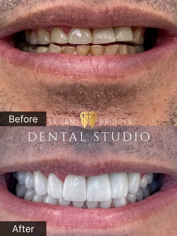 Before and after teeth whitening results showing visibly whiter smile for male patient at Seven Bridges Dental Studio in Woodridge, IL