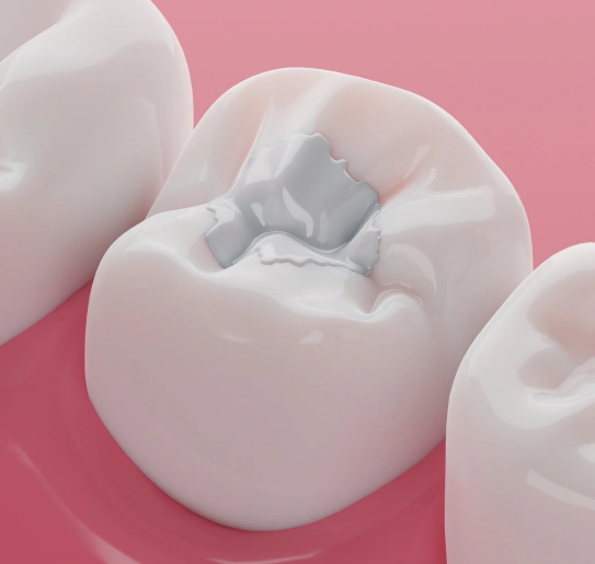 3D model of tooth-colored composite fillings blending naturally with teeth