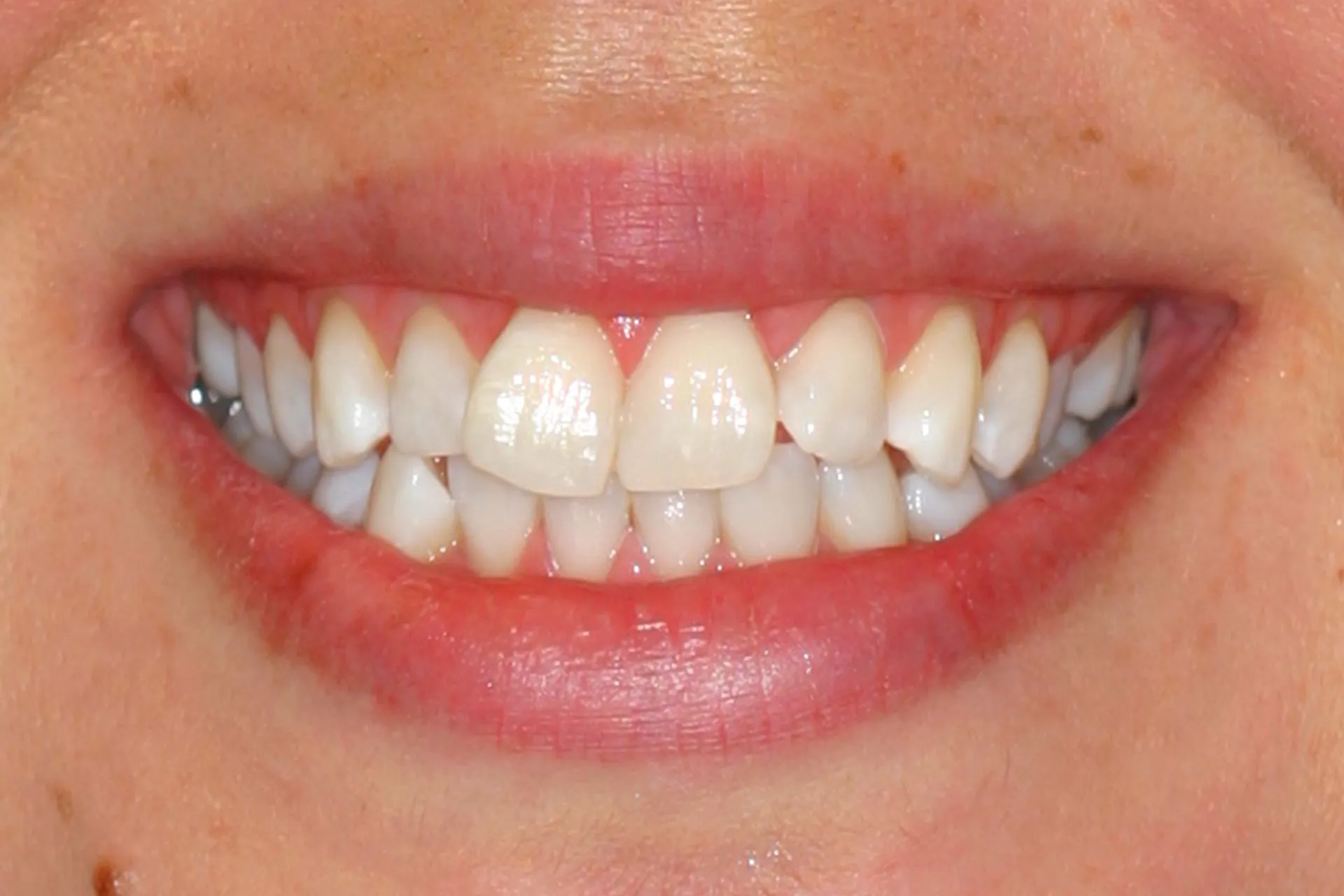 Close-up of a smiling mouth showing teeth and gums after KöR Whitening