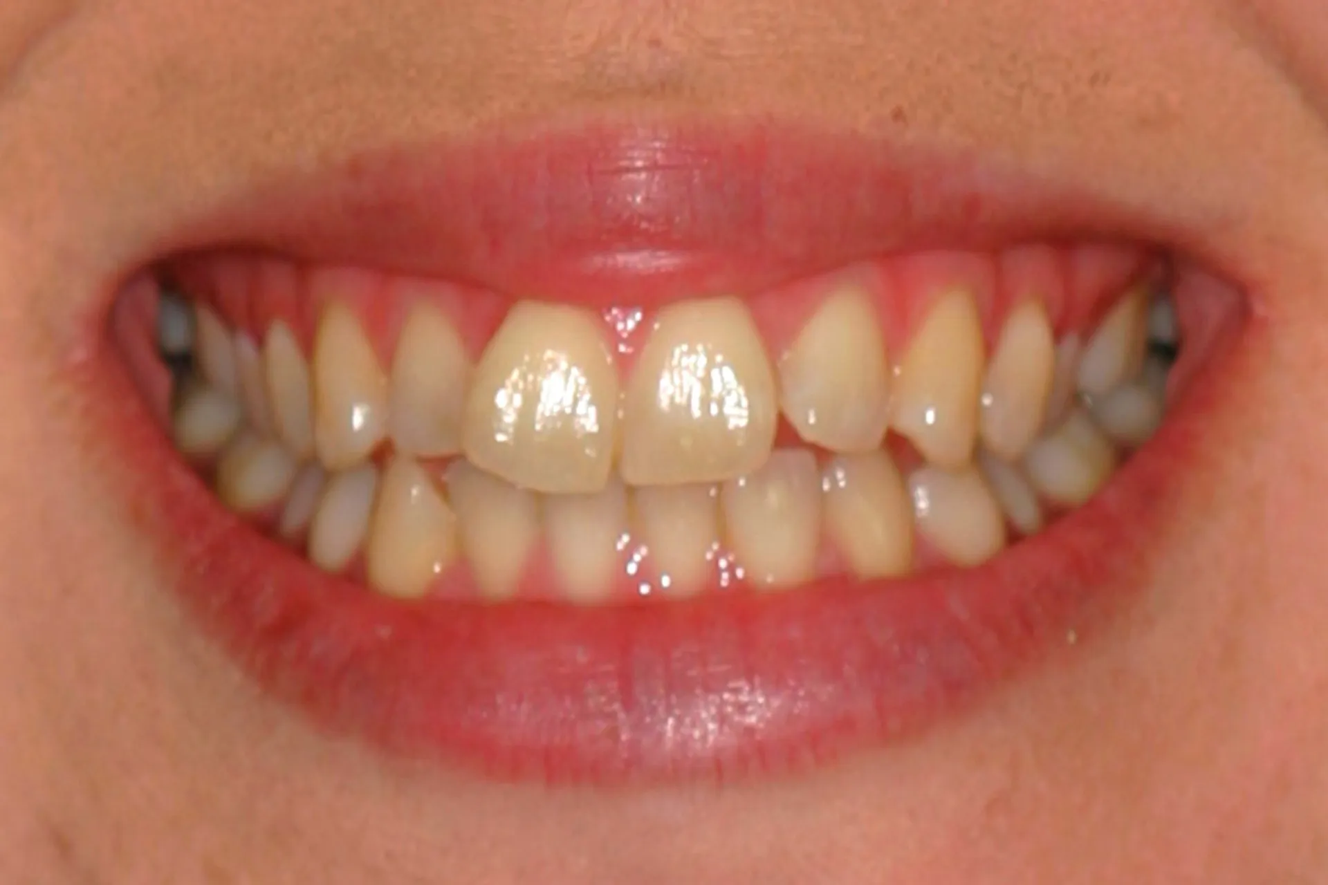 Close-up of a smiling mouth showing teeth and gums before KöR Whitening
