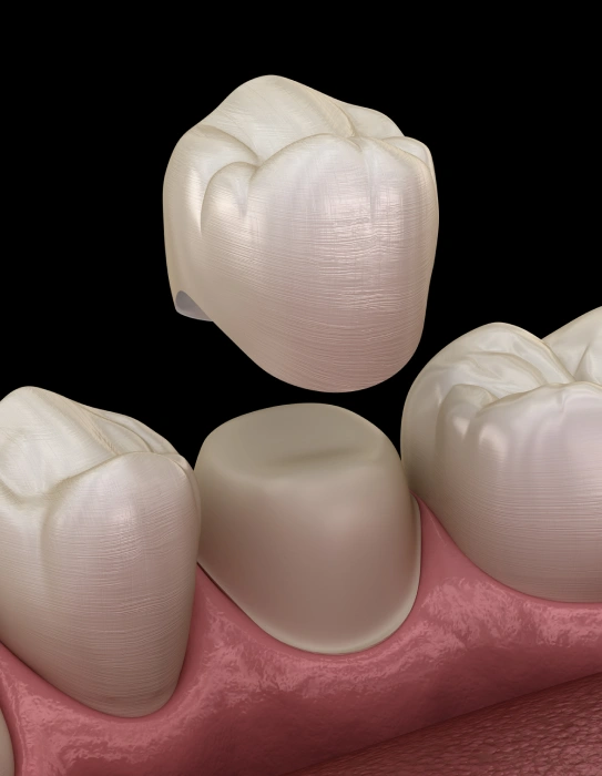 3D model of zirconia and emax dental crowns showing natural tooth-like appearance